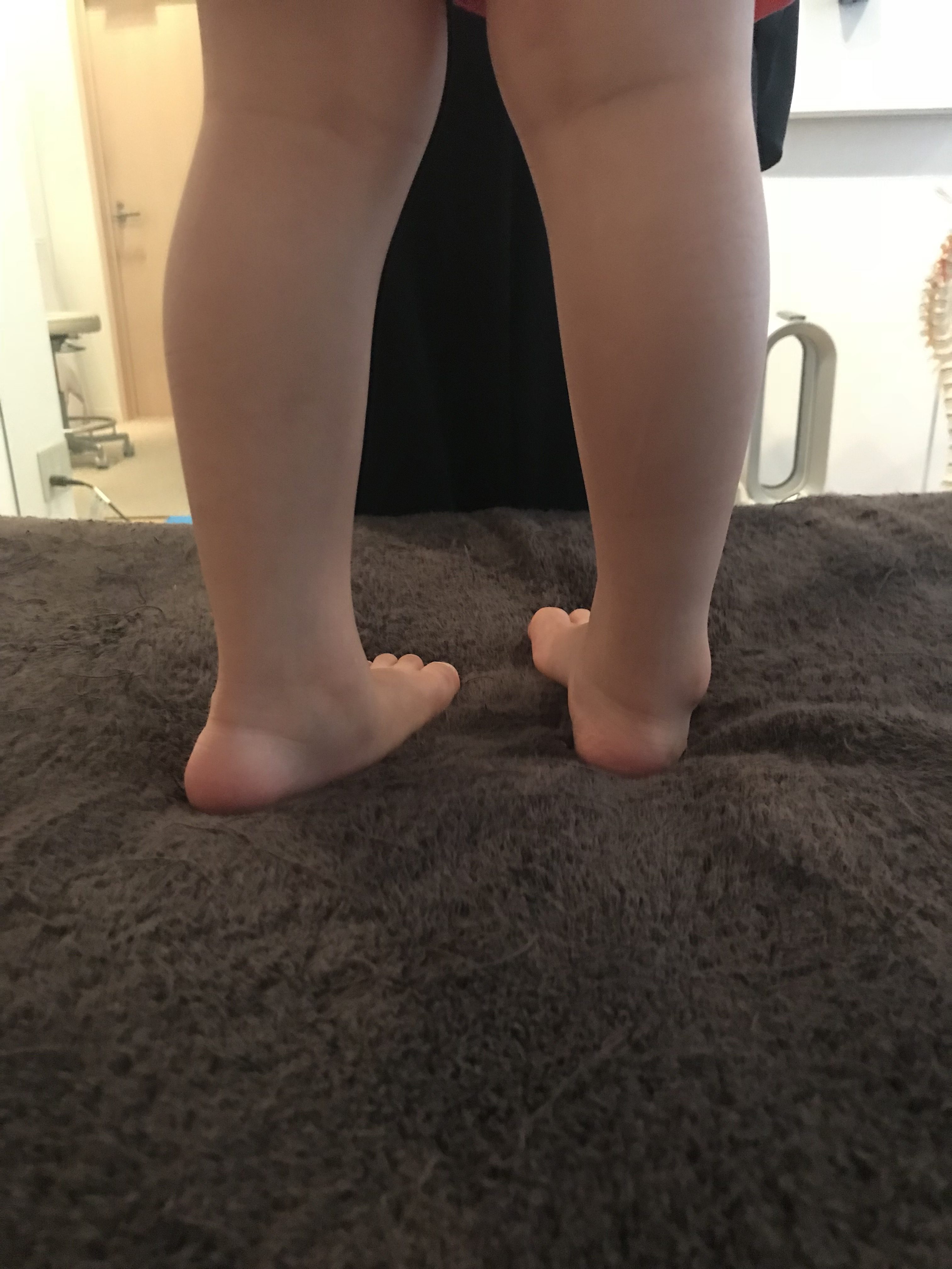 子供の外反母趾の原因とは?